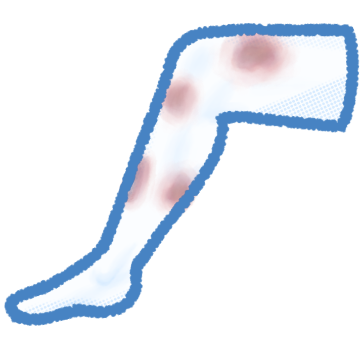 A drawing of a blue and white toned leg with bruises on it.